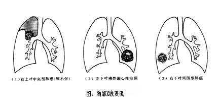 肺的简笔画图片大全